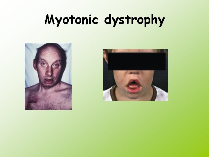 Myotonic dystrophy 