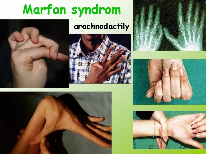 Marfan syndrom arachnodactily 
