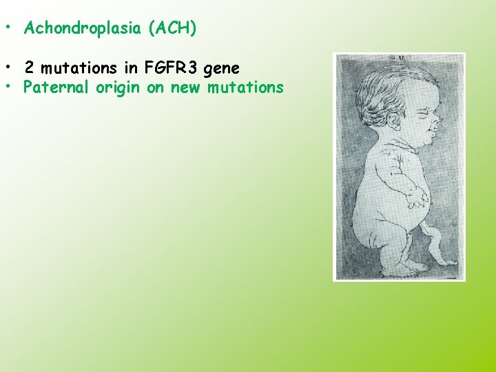  • Achondroplasia (ACH) • 2 mutations in FGFR 3 gene • Paternal origin