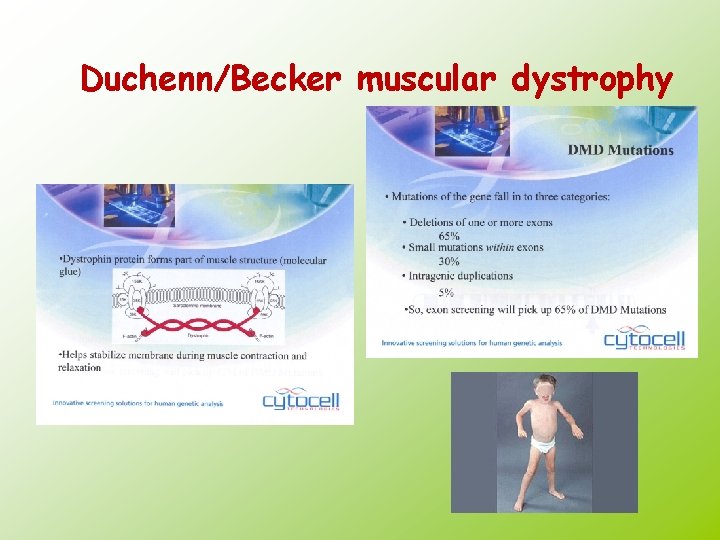 Duchenn/Becker muscular dystrophy 