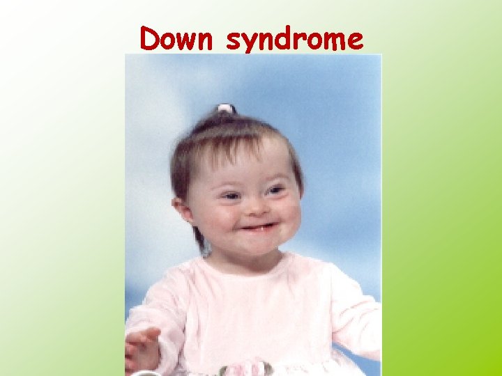 Down syndrome 