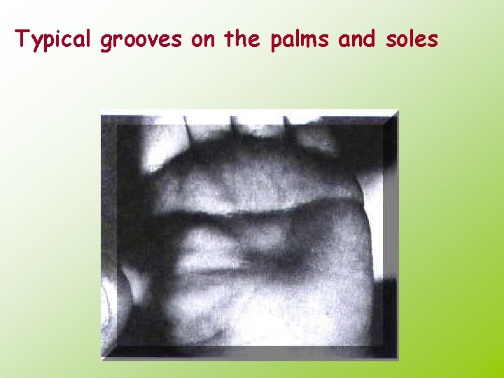 Typical grooves on the palms and soles 