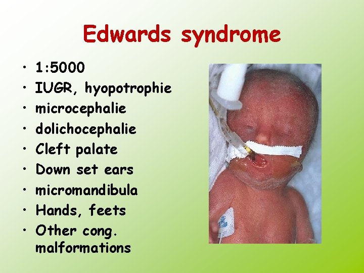 Edwards syndrome • • • 1: 5000 IUGR, hyopotrophie microcephalie dolichocephalie Cleft palate Down