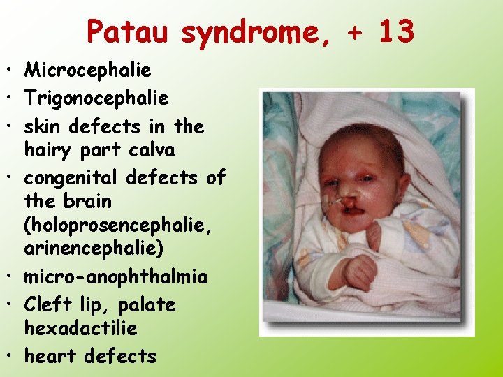 Patau syndrome, + 13 • Microcephalie • Trigonocephalie • skin defects in the hairy