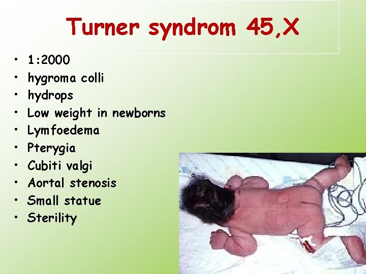 Turner syndrom 45, X • • • 1: 2000 hygroma colli hydrops Low weight