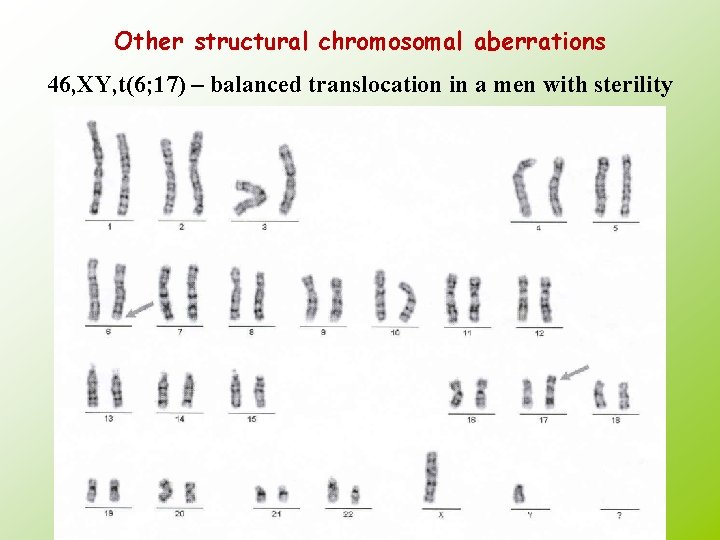 Other structural chromosomal aberrations 46, XY, t(6; 17) – balanced translocation in a men