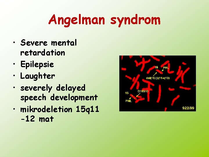 Angelman syndrom • Severe mental retardation • Epilepsie • Laughter • severely delayed speech