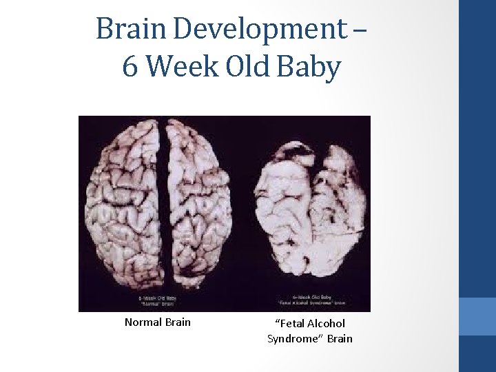 Brain Development – 6 Week Old Baby Normal Brain “Fetal Alcohol Syndrome” Brain 