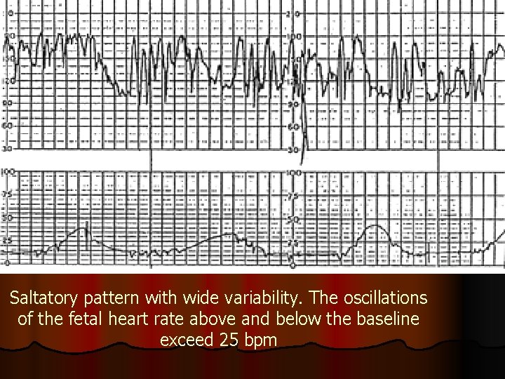 Saltatory pattern with wide variability. The oscillations of the fetal heart rate above and