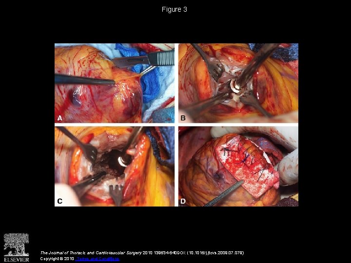 Figure 3 The Journal of Thoracic and Cardiovascular Surgery 2010 139634 -640 DOI: (10.