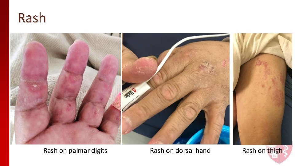 Rash on palmar digits Rash on dorsal hand Rash on thigh Rash on palmar digits Rash on dorsal hand Rash on thigh