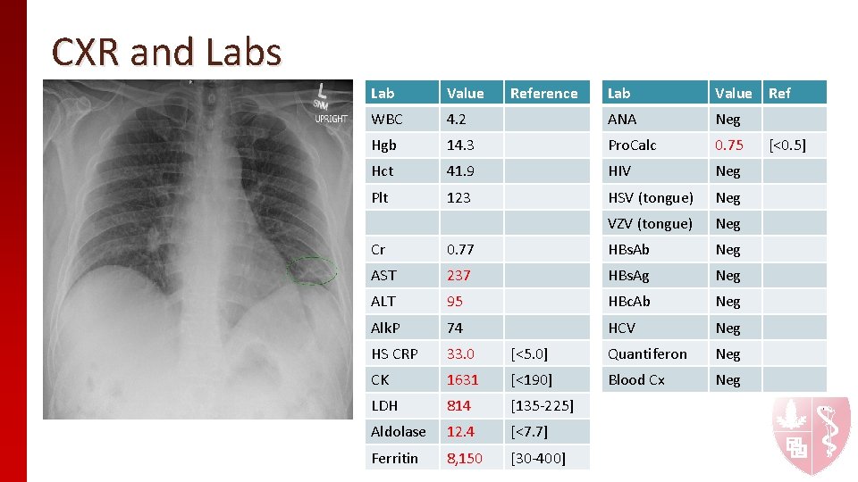 CXR and Labs Lab Value Ref 4. 2 ANA Neg Hgb 14. 3 Pro. CXR and Labs Lab Value Ref 4. 2 ANA Neg Hgb 14. 3 Pro.