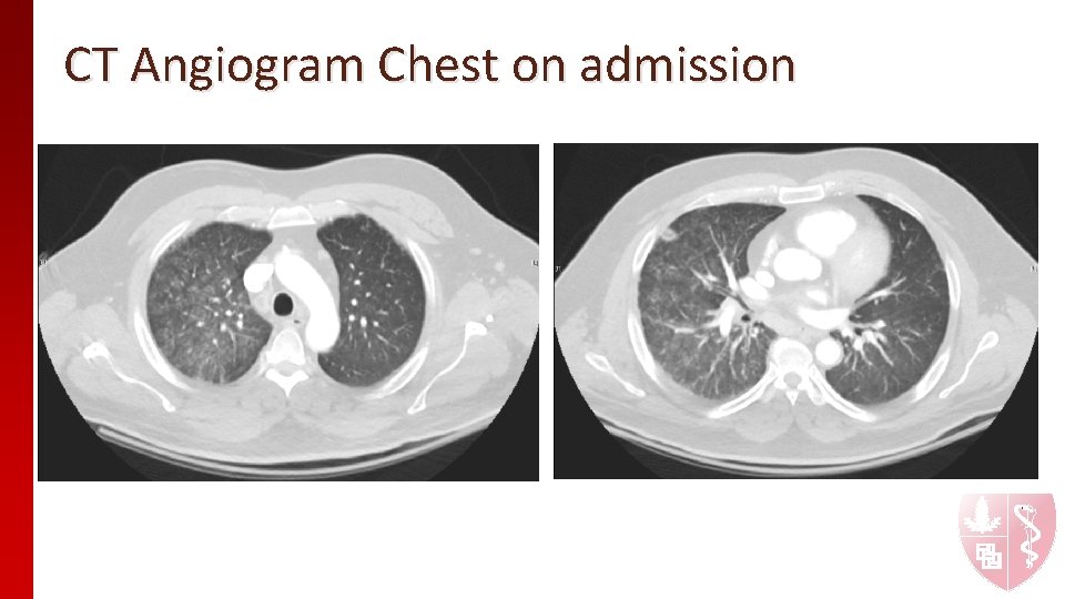 CT Angiogram Chest on admission CT Angiogram Chest on admission