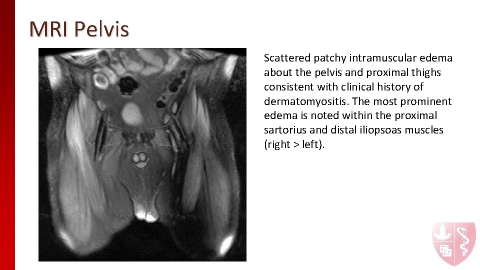MRI Pelvis Scattered patchy intramuscular edema about the pelvis and proximal thighs consistent with MRI Pelvis Scattered patchy intramuscular edema about the pelvis and proximal thighs consistent with