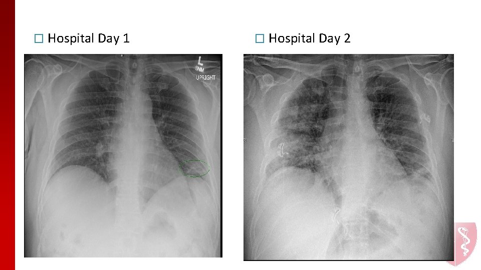 � Hospital Day 1 � Hospital Day 2 � Hospital Day 1 � Hospital Day 2