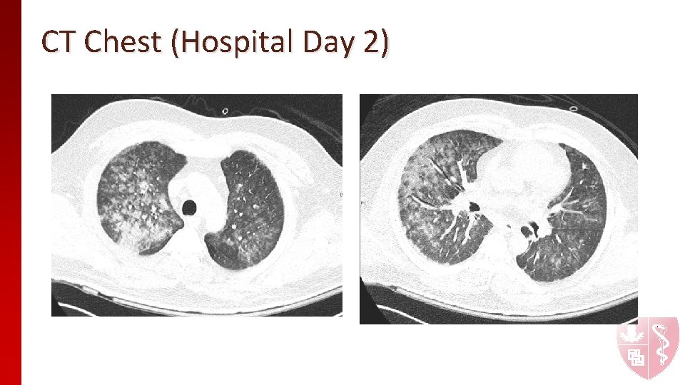CT Chest (Hospital Day 2) CT Chest (Hospital Day 2)