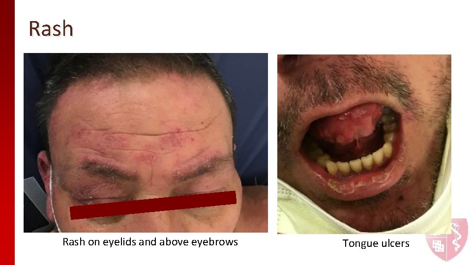 Rash on eyelids and above eyebrows Tongue ulcers Rash on eyelids and above eyebrows Tongue ulcers