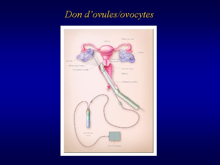 Don d’ovules/ovocytes 