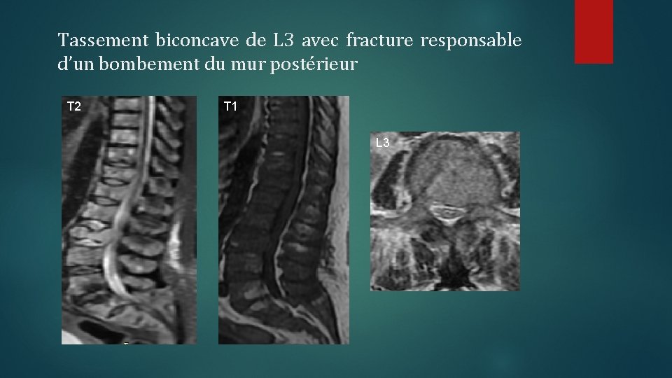 apport-de-lirm-vertebromdullaire-dans-le-diagnostic-et