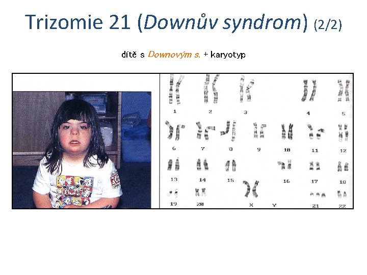 Trizomie 21 (Downův syndrom) (2/2) dítě s Downovým s. + karyotyp 