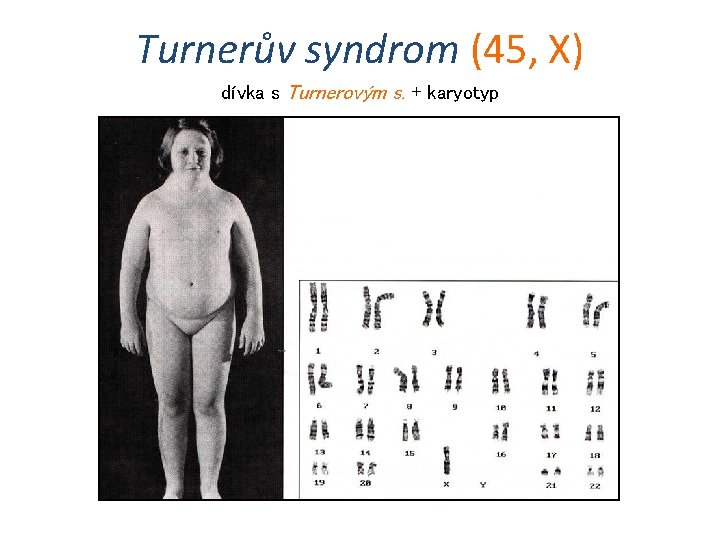 Turnerův syndrom (45, X) dívka s Turnerovým s. + karyotyp 