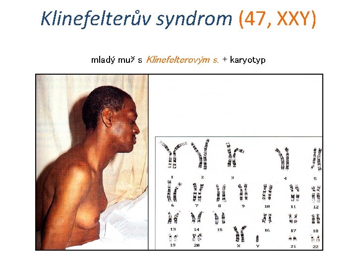 Klinefelterův syndrom (47, XXY) mladý muž s Klinefelterovým s. + karyotyp 