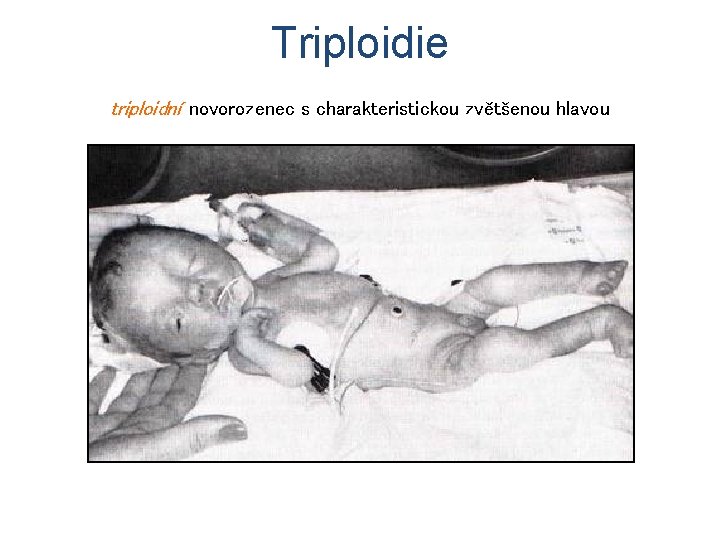 Triploidie triploidní novorozenec s charakteristickou zvětšenou hlavou 