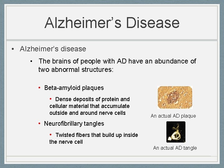 Alzheimer’s Disease • Alzheimer’s disease • The brains of people with AD have an