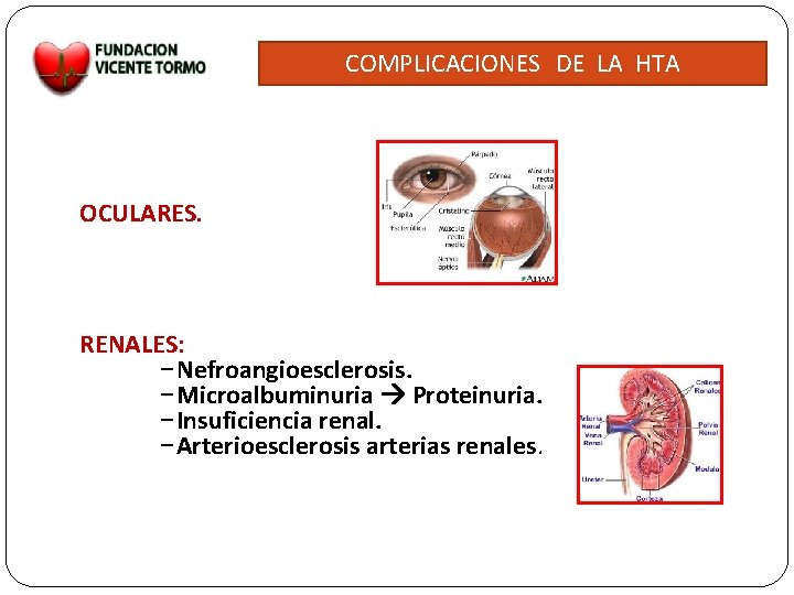 COMPLICACIONES DE LA HTA OCULARES. RENALES: –Nefroangioesclerosis. –Microalbuminuria Proteinuria. –Insuficiencia renal. –Arterioesclerosis arterias renales.