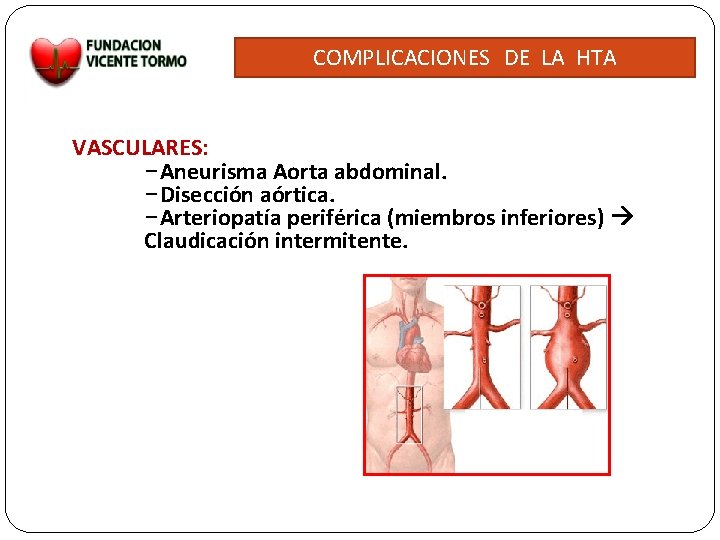 COMPLICACIONES DE LA HTA VASCULARES: –Aneurisma Aorta abdominal. –Disección aórtica. –Arteriopatía periférica (miembros inferiores)