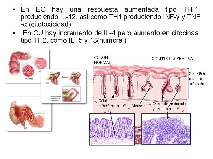 • En EC hay una respuesta aumentada tipo TH-1 produciendo IL-12, así como • En EC hay una respuesta aumentada tipo TH-1 produciendo IL-12, así como