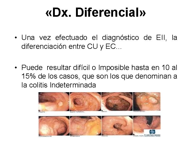 «Dx. Diferencial» • Una vez efectuado el diagnóstico de EII, la diferenciación entre «Dx. Diferencial» • Una vez efectuado el diagnóstico de EII, la diferenciación entre