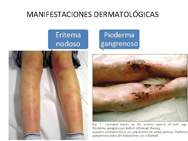 MANIFESTACIONES DERMATOLÓGICAS Eritema nodoso Pioderma gangrenoso EC-15% EC-Menor frecuencia CU-10% CU- 1 -12% MANIFESTACIONES DERMATOLÓGICAS Eritema nodoso Pioderma gangrenoso EC-15% EC-Menor frecuencia CU-10% CU- 1 -12%