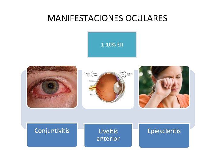 MANIFESTACIONES OCULARES 1 -10% EII Conjuntivitis Uveítis anterior Epiescleritis MANIFESTACIONES OCULARES 1 -10% EII Conjuntivitis Uveítis anterior Epiescleritis