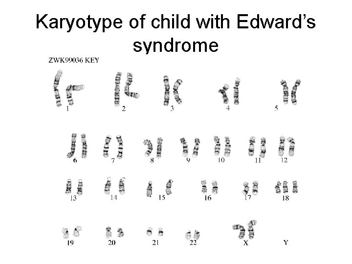 Karyotype of child with Edward’s syndrome 
