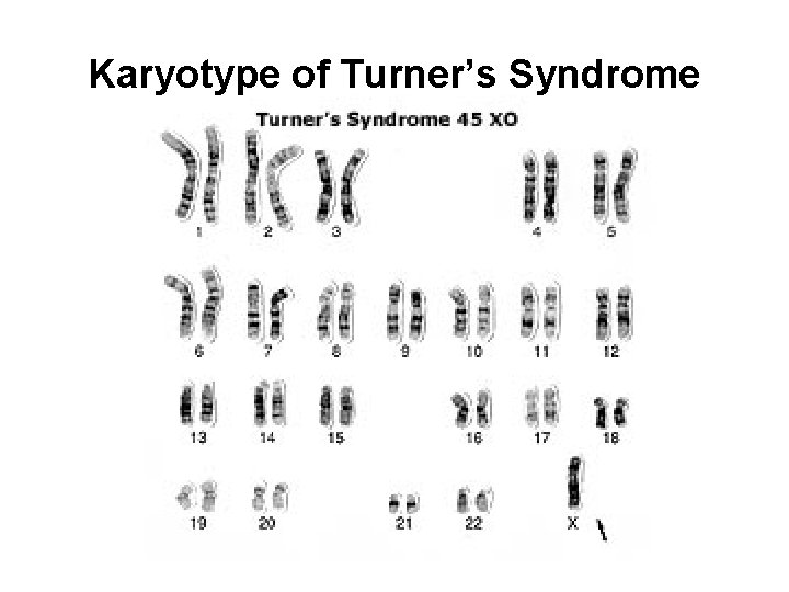 Karyotype of Turner’s Syndrome 