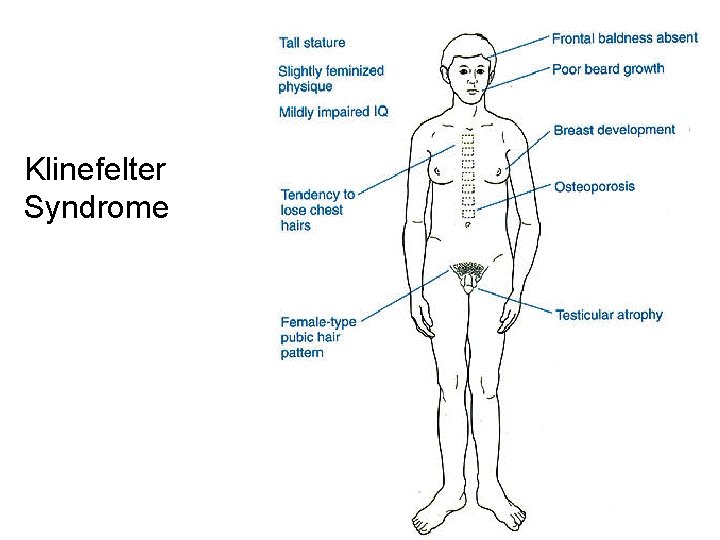 Klinefelter Syndrome 