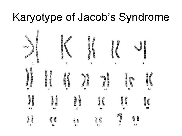 Karyotype of Jacob’s Syndrome 