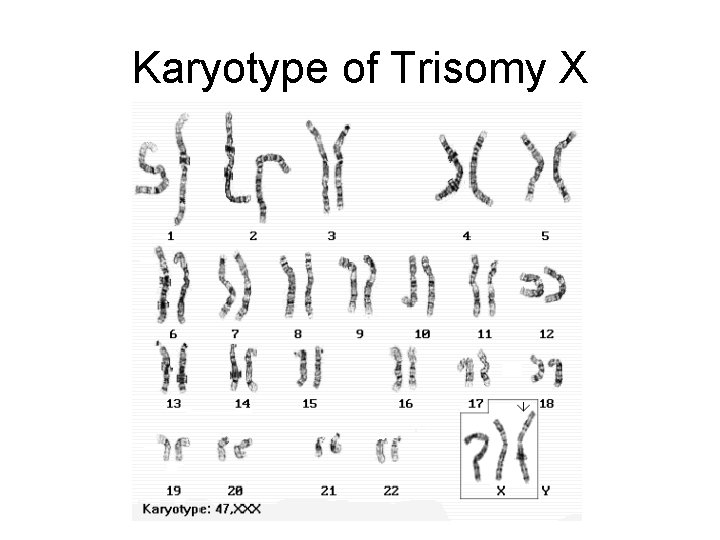 Karyotype of Trisomy X 