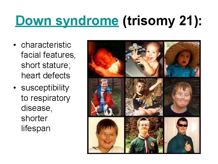 Down syndrome (trisomy 21): • characteristic facial features, short stature; heart defects • susceptibility