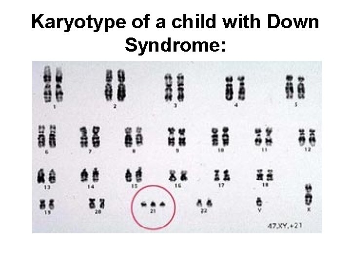 Karyotype of a child with Down Syndrome: 