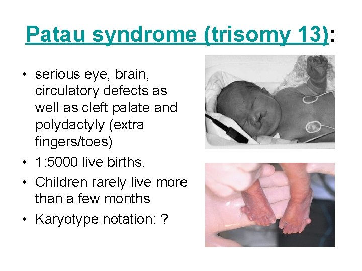 Patau syndrome (trisomy 13): • serious eye, brain, circulatory defects as well as cleft