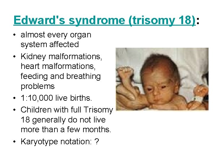 Edward's syndrome (trisomy 18): • almost every organ system affected • Kidney malformations, heart