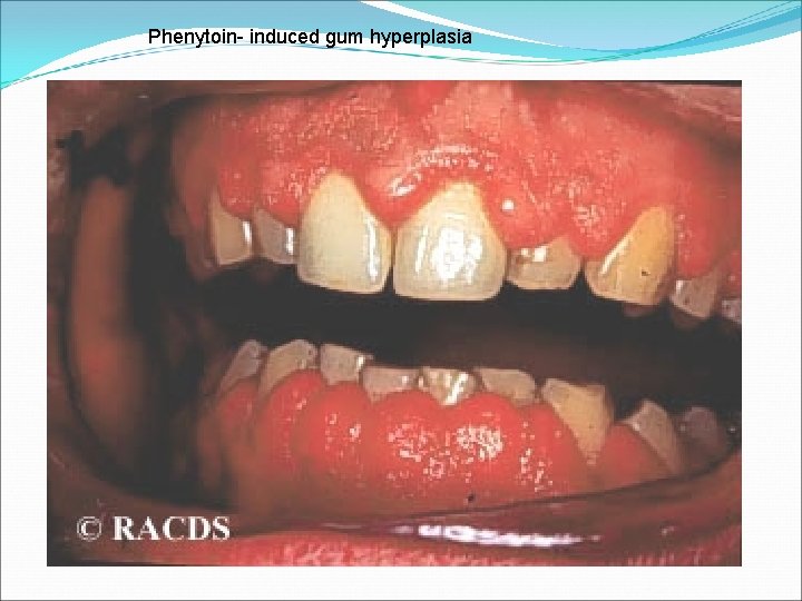Phenytoin- induced gum hyperplasia 