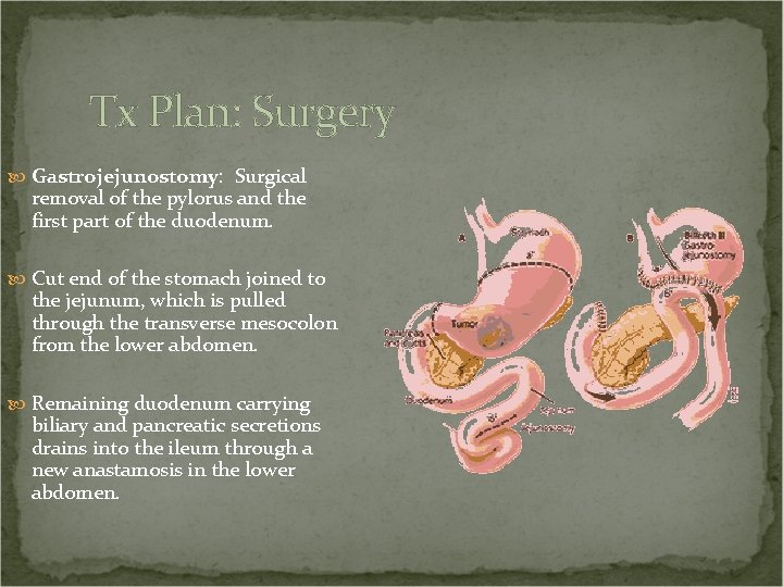 Tx Plan: Surgery Gastrojejunostomy: Surgical removal of the pylorus and the first part of