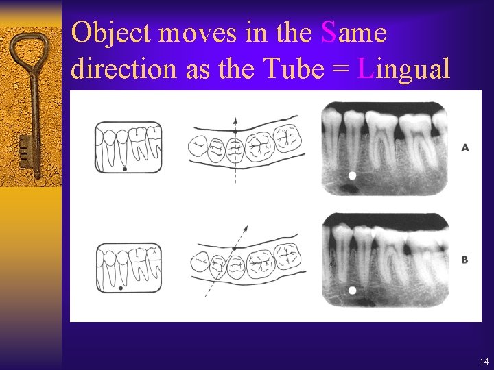 Object moves in the Same direction as the Tube = Lingual 14 Object moves in the Same direction as the Tube = Lingual 14