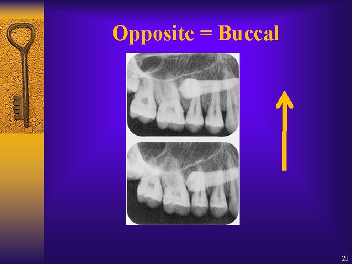 Opposite = Buccal 20 Opposite = Buccal 20