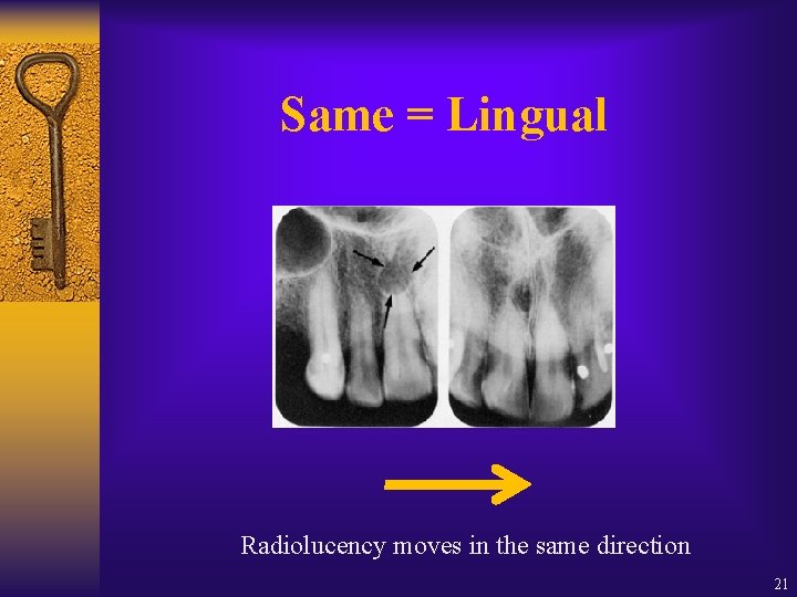 Same = Lingual Radiolucency moves in the same direction 21 Same = Lingual Radiolucency moves in the same direction 21