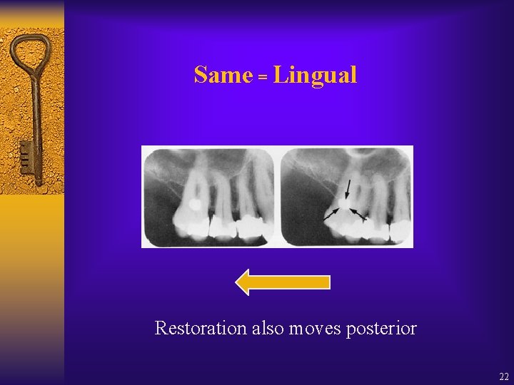 Same = Lingual Restoration also moves posterior 22 Same = Lingual Restoration also moves posterior 22