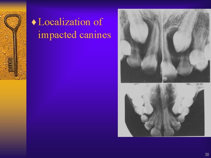¨ Localization of impacted canines 30 ¨ Localization of impacted canines 30